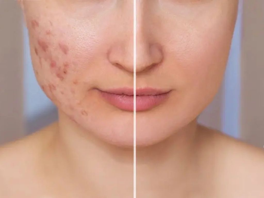 Acne Scar Treatment
