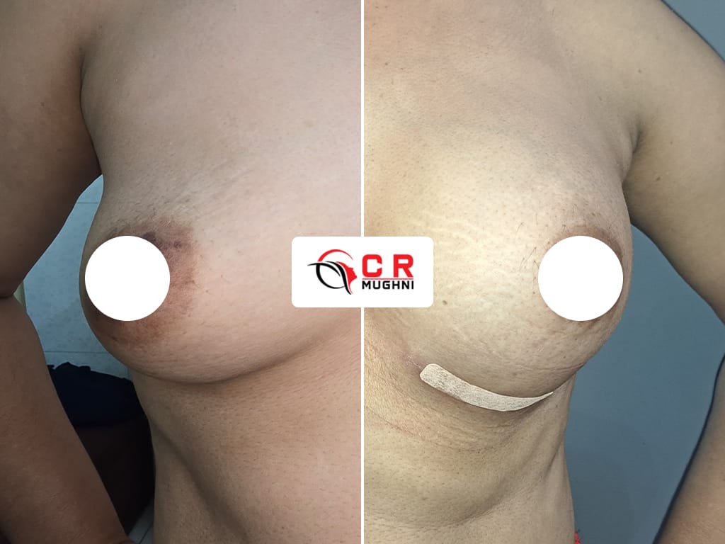 Breast Augmentation