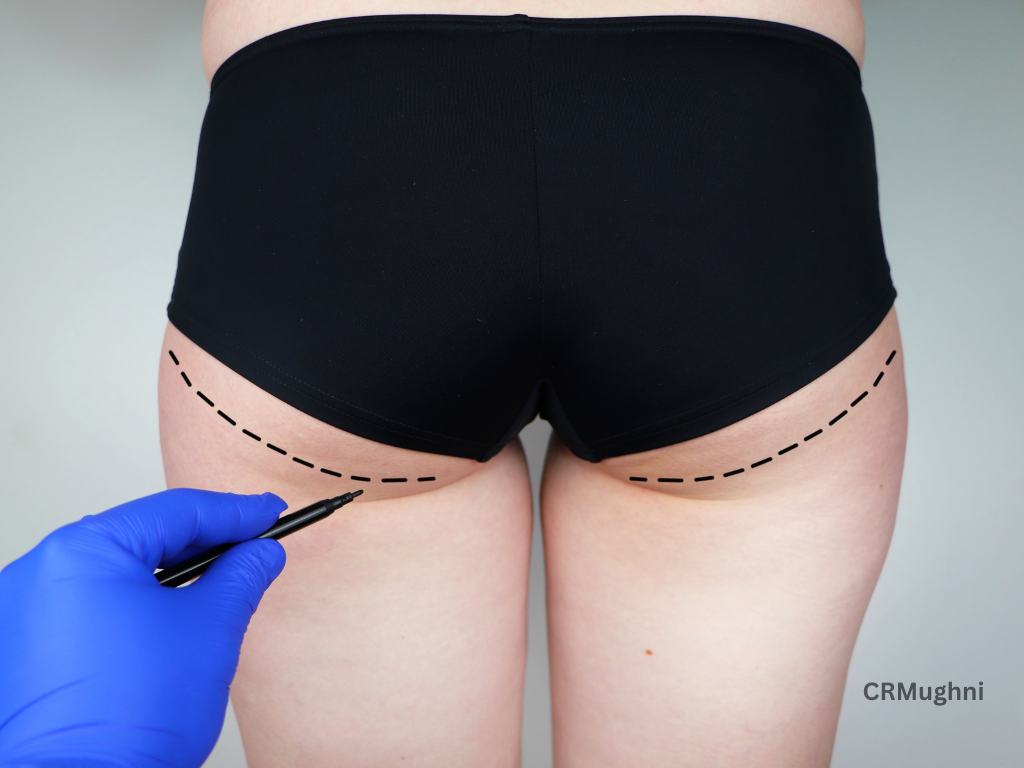 Buttock Augmentation