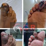 Diabetic Foot Surgery