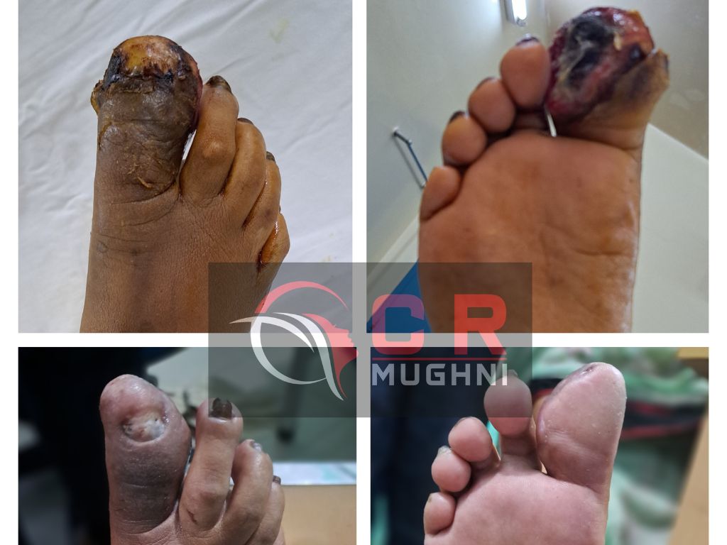 Diabetic Foot Surgery