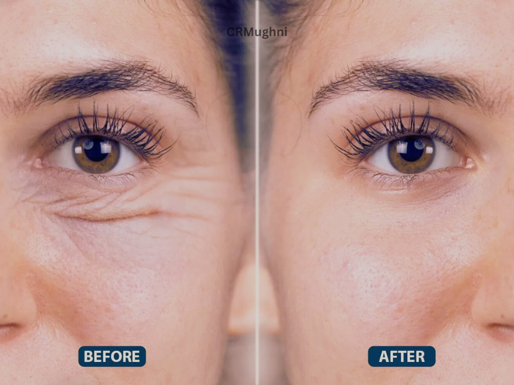 Blepharoplasty (Eyelid Surgery)