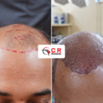 Hair Transplant