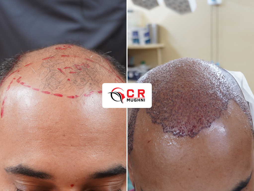 Hair Transplant