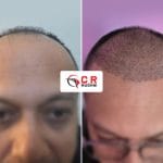Hair Transplant