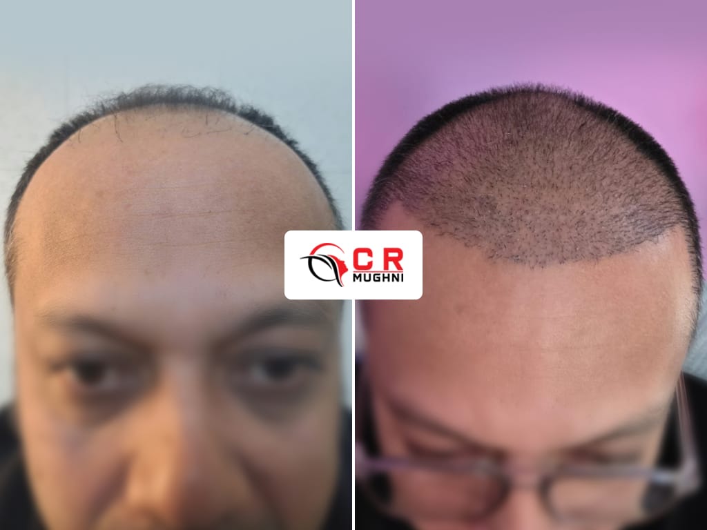 Hair Transplant