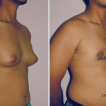 Gynecomastia