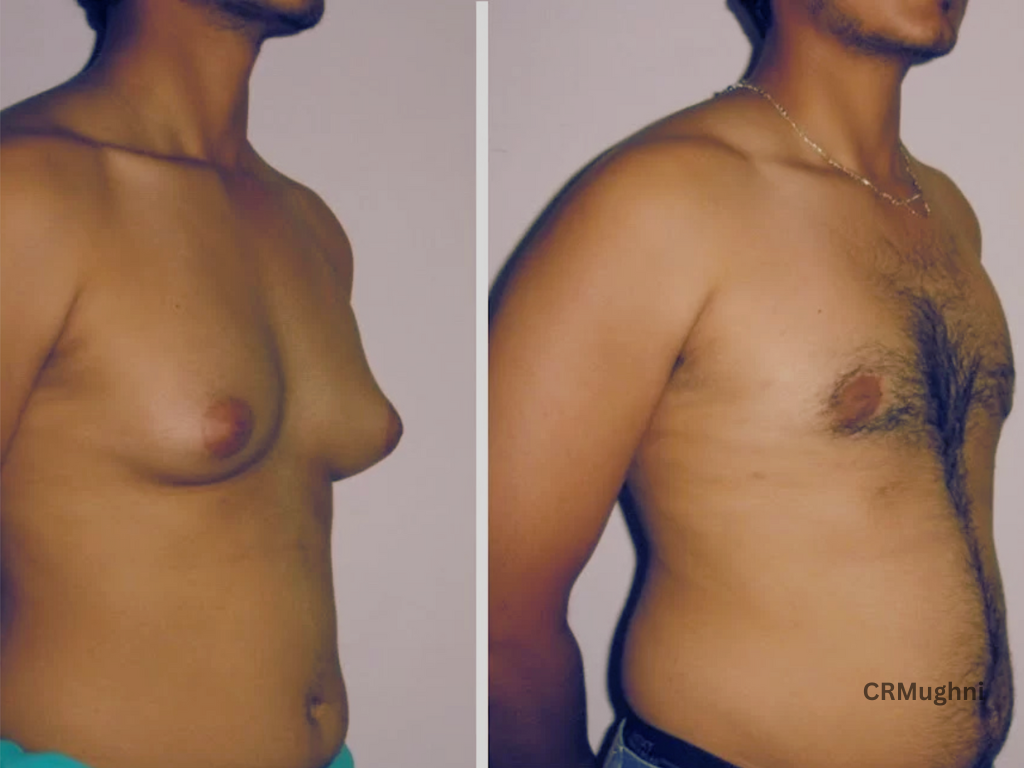 Gynecomastia