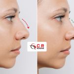 Rhinoplasty