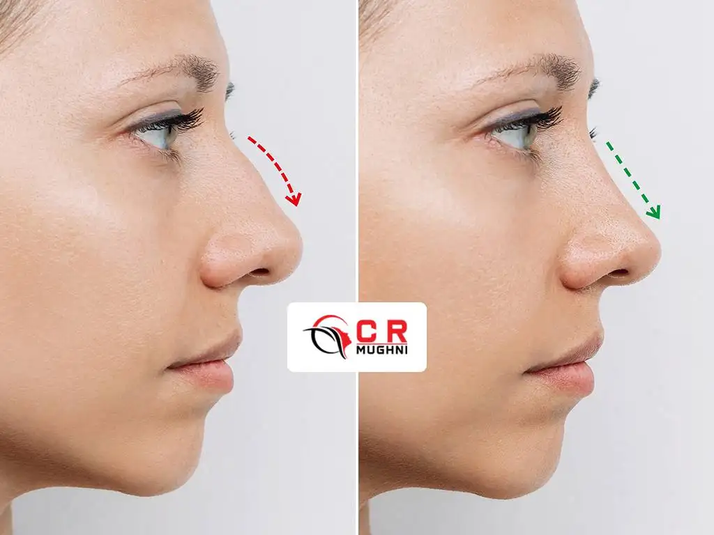 Rhinoplasty - Plastic Surgery Dr. Mughni