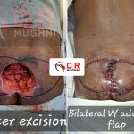 Bed Sores (Pressure Ulcers)