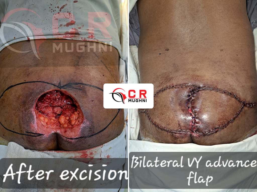 Bed Sores (Pressure Ulcers)