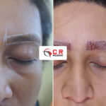 Eyebrow Transplant
