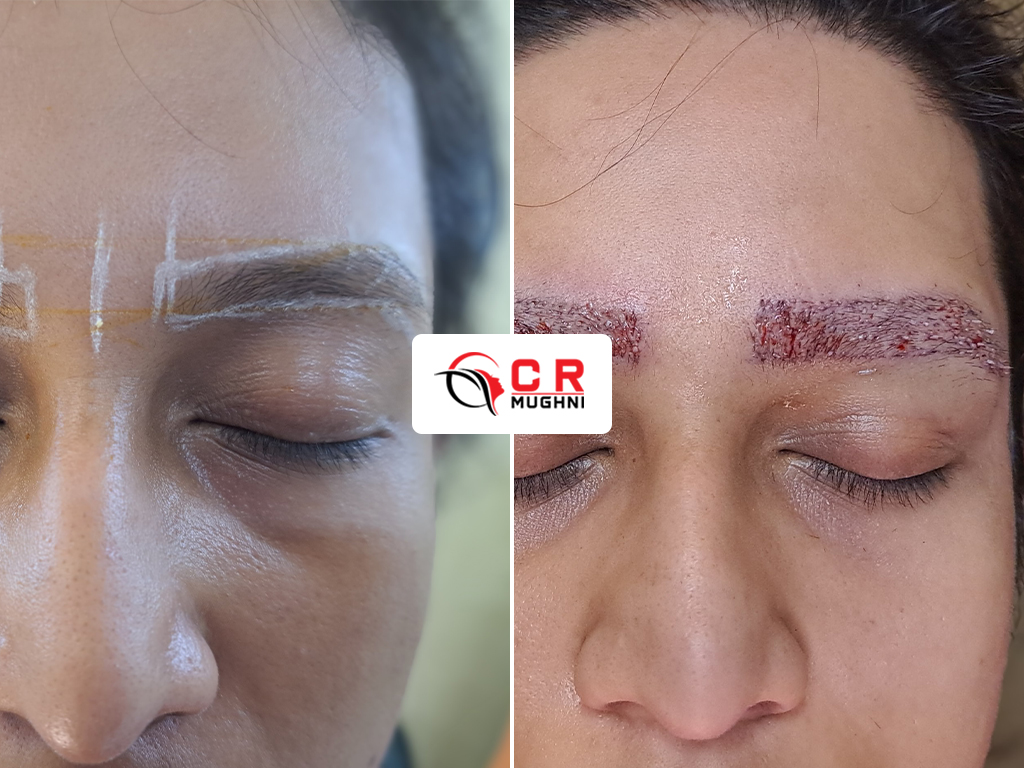 Eyebrow Transplant