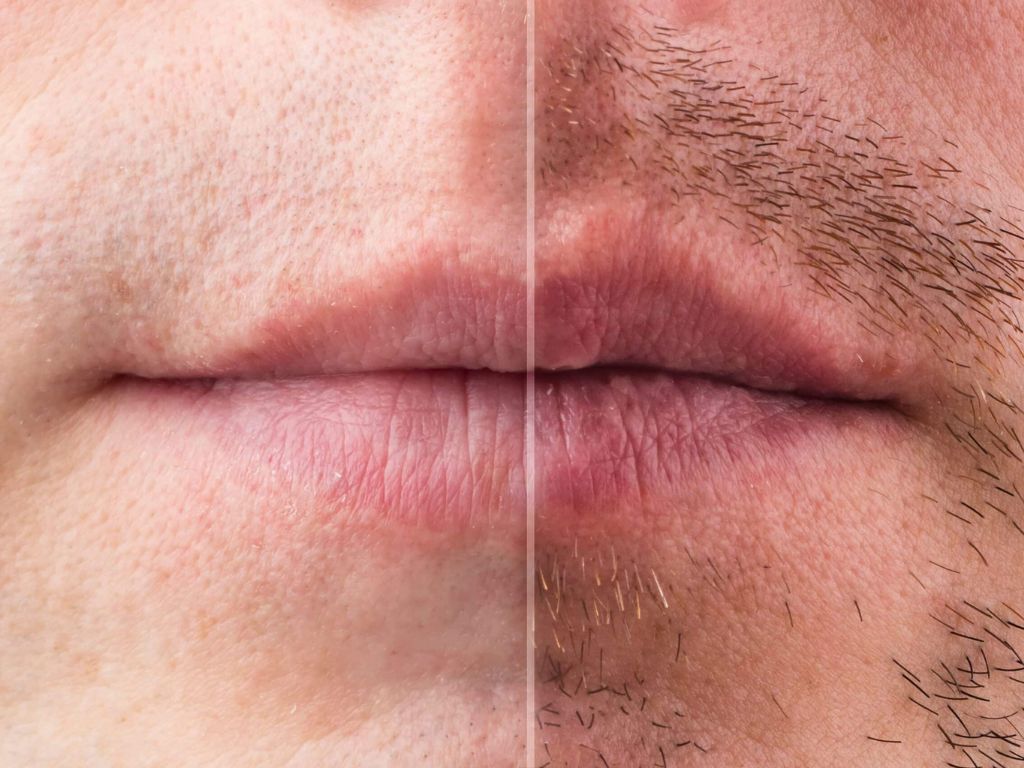 Mustache Transplant