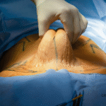 Lipoabdominoplasty