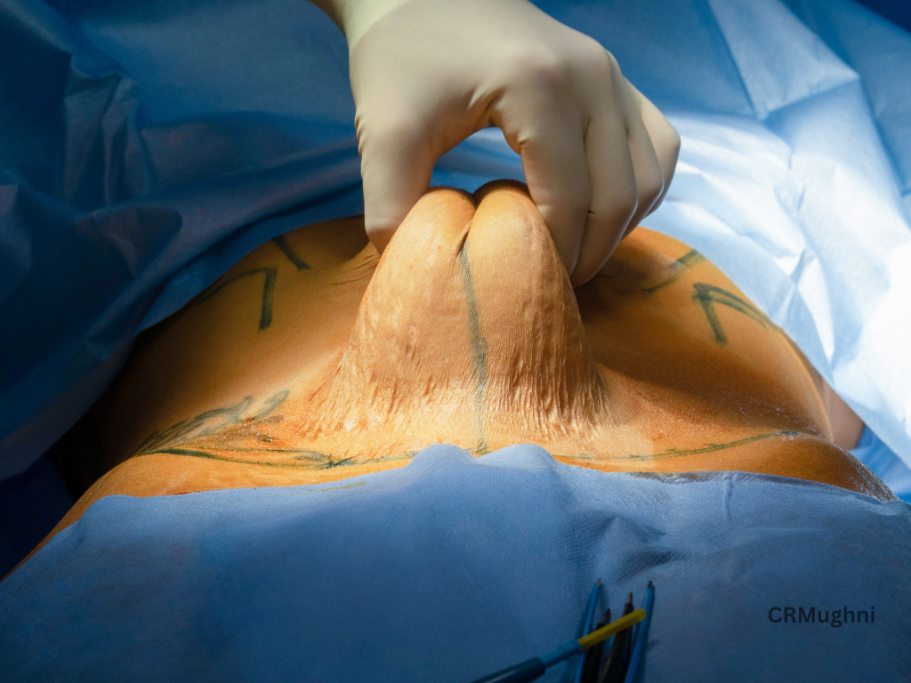 Lipoabdominoplasty