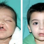 Cleft Lip & Palate