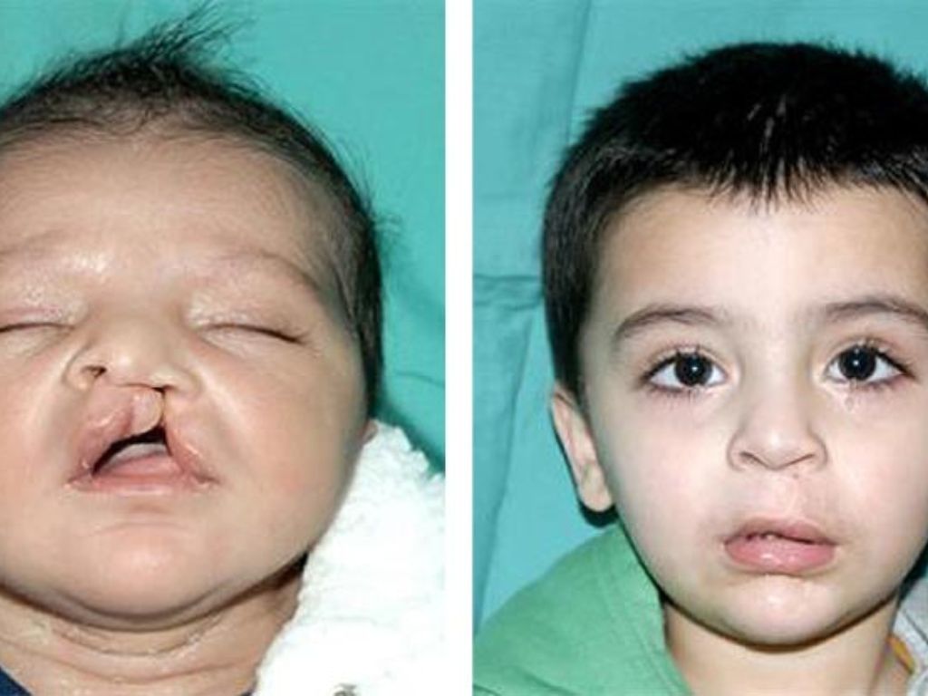 Cleft Lip & Palate