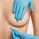 Mastopexy (Breast Lift)