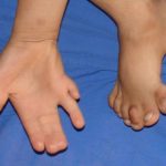 Polydactyly & Syndactyly