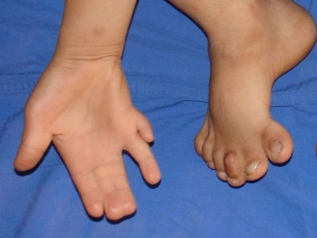 Polydactyly & Syndactyly